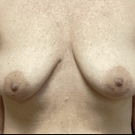 Breast Augmentation Before & After Patient #298