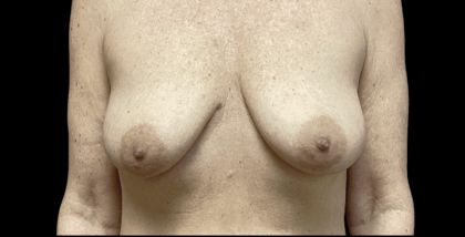 Breast Augmentation Before & After Patient #298
