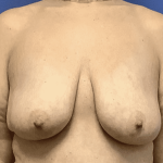 Breast Augmentation Before & After Patient #307