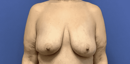 Breast Augmentation Before & After Patient #307