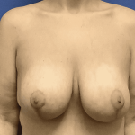 Breast Augmentation Before & After Patient #307