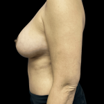 Breast Augmentation Before & After Patient #313