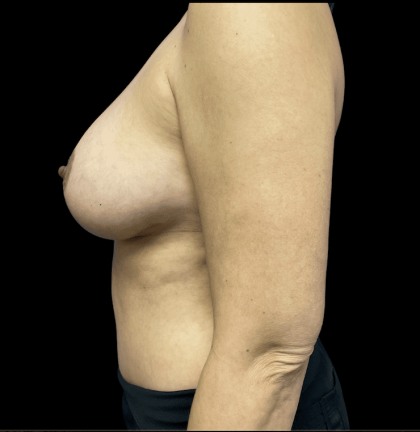 Breast Augmentation Before & After Patient #313