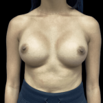 Breast Augmentation Before & After Patient #318