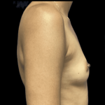 Breast Augmentation Before & After Patient #318