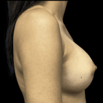 Breast Augmentation Before & After Patient #318