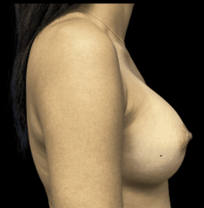 Breast Augmentation Before & After Patient #318