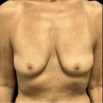 Breast Augmentation Before & After Patient #328