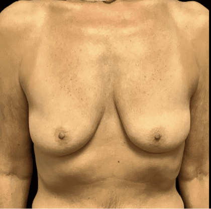 Breast Augmentation Before & After Patient #328