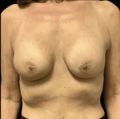 Breast Augmentation Before & After Patient #328