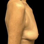 Breast Augmentation Before & After Patient #328