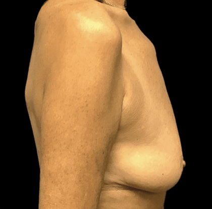 Breast Augmentation Before & After Patient #328