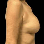 Breast Augmentation Before & After Patient #328