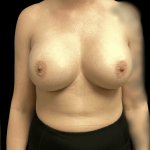 Breast Augmentation Before & After Patient #333