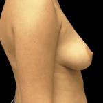 Breast Augmentation Before & After Patient #333