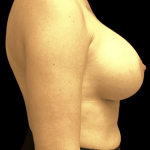 Breast Augmentation Before & After Patient #333
