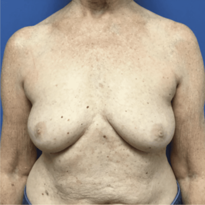 Breast Augmentation Before & After Patient #338