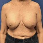 Breast Augmentation Before & After Patient #338