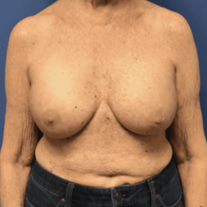 Breast Augmentation Before & After Patient #338