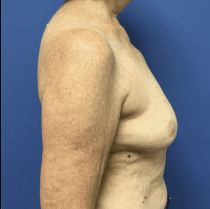 Breast Augmentation Before & After Patient #338