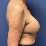Breast Augmentation Before & After Patient #338