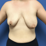 Breast Augmentation Before & After Patient #343