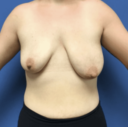 Breast Augmentation Before & After Patient #343