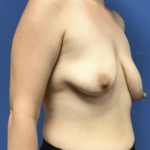 Breast Augmentation Before & After Patient #343