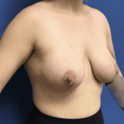 Breast Augmentation Before & After Patient #343