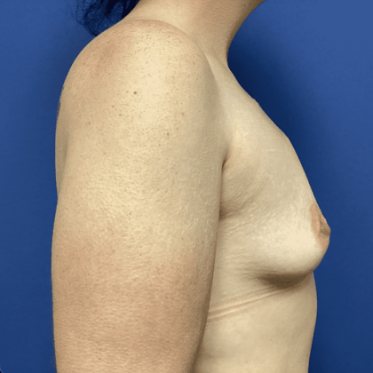 Breast Augmentation Before & After Patient #358