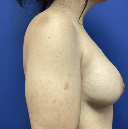 Breast Augmentation Before & After Patient #358