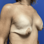 Breast Augmentation Before & After Patient #363