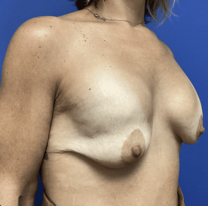 Breast Augmentation Before & After Patient #363