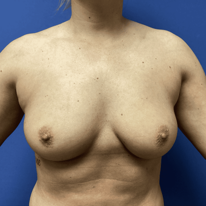 Breast Augmentation Before & After Patient #368