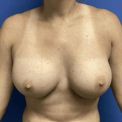 Breast Augmentation Before & After Patient #368