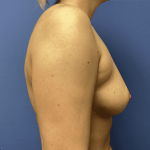 Breast Augmentation Before & After Patient #368