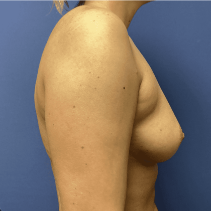Breast Augmentation Before & After Patient #368