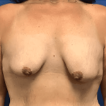 Breast Augmentation Before & After Patient #373