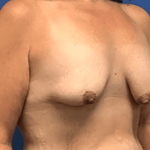 Breast Augmentation Before & After Patient #373