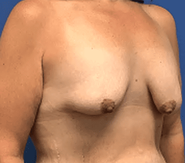 Breast Augmentation Before & After Patient #373