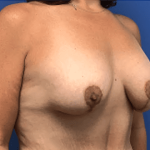 Breast Augmentation Before & After Patient #373