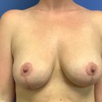 Breast Augmentation Before & After Patient #378