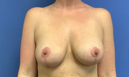 Breast Augmentation Before & After Patient #378