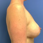 Breast Augmentation Before & After Patient #378