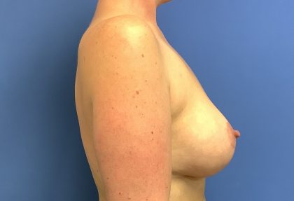 Breast Augmentation Before & After Patient #378