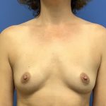 Breast Augmentation Before & After Patient #383