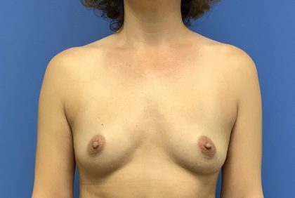 Breast Augmentation Before & After Patient #383