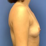 Breast Augmentation Before & After Patient #383