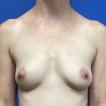 Breast Augmentation Before & After Patient #388