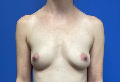 Breast Augmentation Before & After Patient #388